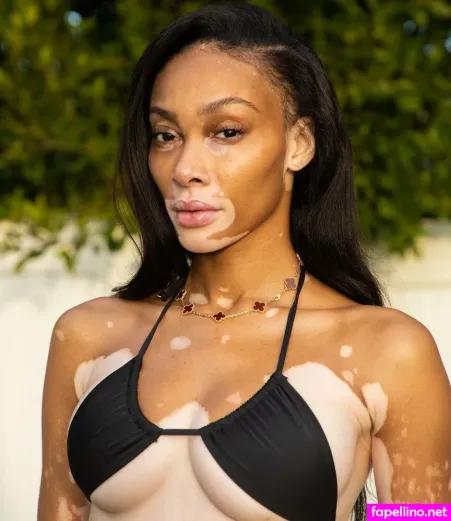Winnie Harlow OnlyFans Thumbnail #QChKaDEG9e