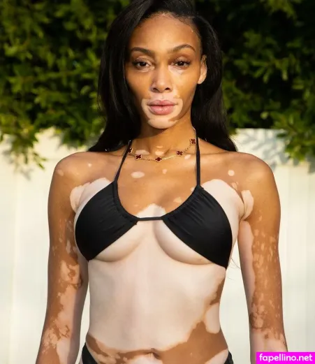 Winnie Harlow OnlyFans Thumbnail #d5RYMDKgBZ